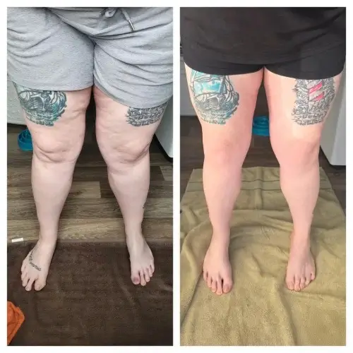 Resultado Lymphoderm